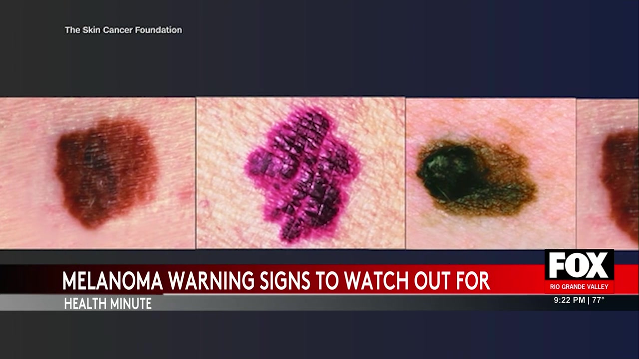 WATCH: How To Protect Yourself From Deadly Melanoma Skin Cancer