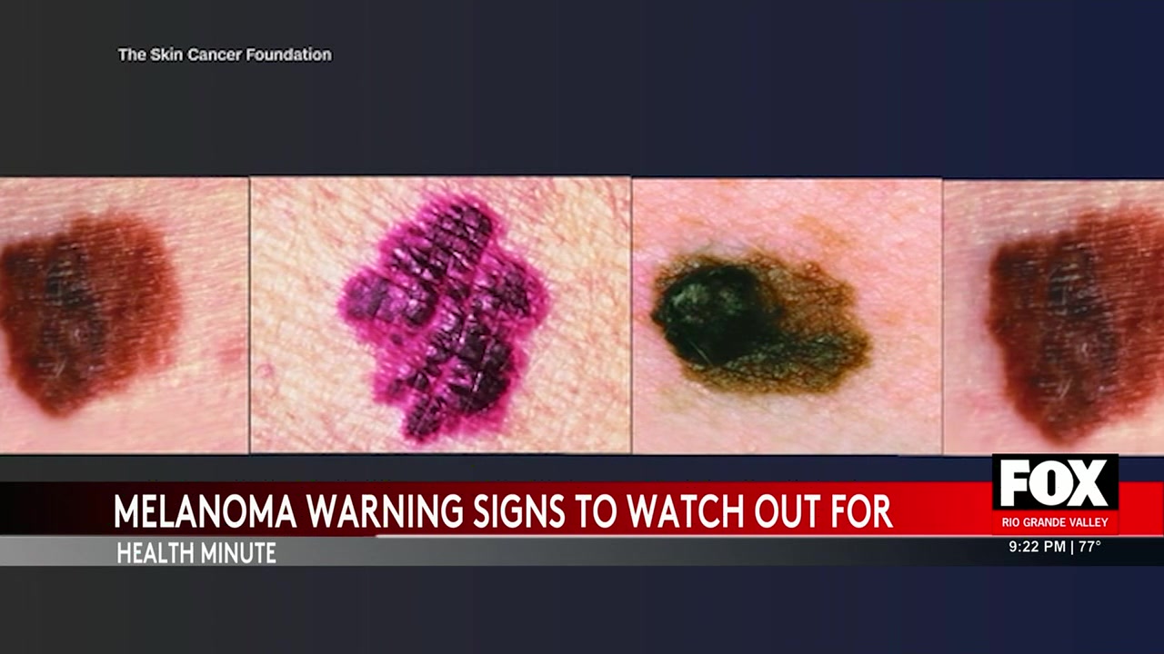 Melanoma Monday: Experts Warn Of Skin Cancer Symptoms And Urge Early ...